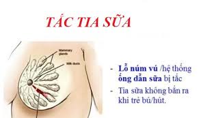 Bài thuốc trị viêm mủ cấp Tuyến vú ( Tắc sữa)