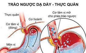 Bài thuốc trị trào ngược dạ dày - thực quản
