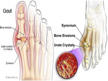 Trị bệnh gout (gút) bằng quả chuối hột và củ ráy