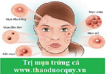 Bài thuốc trị mụn trứng cá
