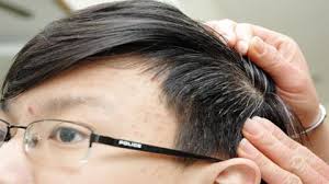 Điều trị tóc bạc ở trẻ em