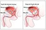 Đông y chữa Phì đại tuyến tiền liệt