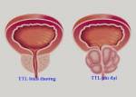 Bài thuốc trị U xơ tuyến tiền liệt